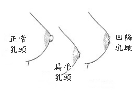 乳頭矯正器